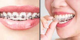 Braces vs Aligners: Comparison of Orthodontic Treatment Options at Italian Dental Clinic Dubai