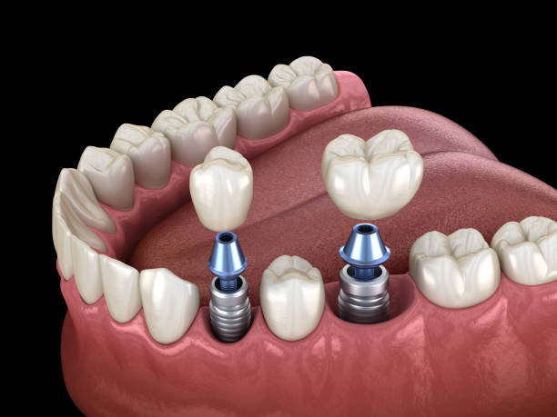 Dental implant procedure at Italian Dental Clinic in Healthcare City, Dubai