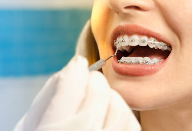 Orthodontic braces at Italian Dental Clinic in Healthcare City, Dubai