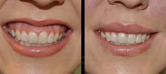 Patient undergoing gummy smile treatment Dubai with Botox and surgery options.