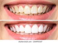 Before and after teeth whitening results