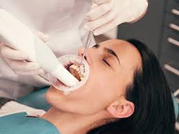 Professional teeth cleaning in Dubai, showcasing dental cleaning techniques to remove stains from teeth using dental scaling.
