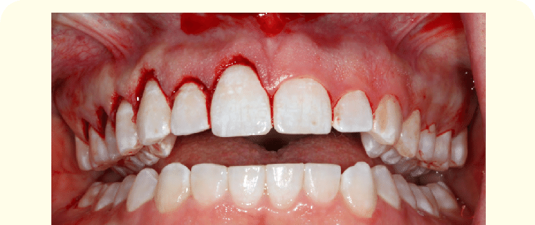 Gingivectomy procedure performed by a gum specialist in Dubai to treat gum disease and inflammation.