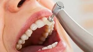 Teeth Cleaning, Dental Cleaning Dubai, Dental Scaling, Tartar Removal for a Healthier Smile