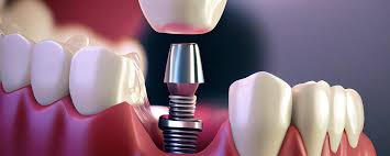 Dental implants in Dubai, same day dental implants, implants Dubai, dental implantologist, all on 4 dental implants.